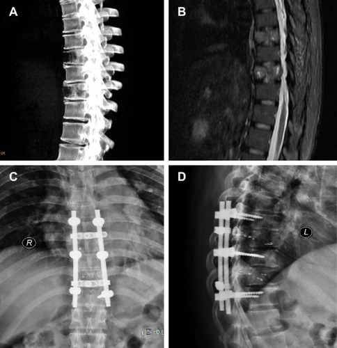 Figure 3 Computed tomography (CT) and magnetic resonance imaging scan of spine.
