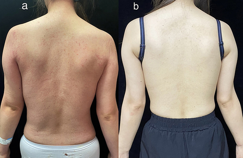 Figure 1 (a) The patient exhibited symmetrical whip-like lesions on the back and the shoulders accompanied by pruritus. (b) Significant improvement and disappearance of the skin lesions were observed following treatment with TCZ.