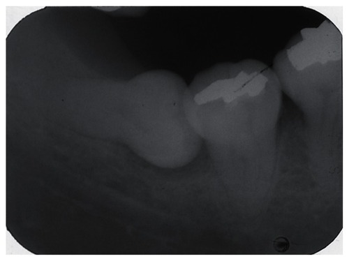 Figure 5 Right mandibular third molar of a 49-year-old woman with acute pericoronitis.