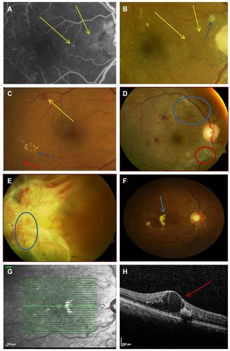 Figure 1 Retinal signs of diabetic retinopathy.