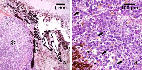 Figure 2. A: Histopathological section of the tumor mass stained with hematoxylin and eosin (magnification: 4×): Iris is infiltrated by a densely cellular neoplastic proliferation (asterisk). B: Histopathological section of the tumor mass stained with hematoxylin and eosin (magnification 40×): The neoplastic cells appear pleomorphic, rarely pigmented (arrowheads), with high nucleus-to-cytoplasm ratio and show numerous mitoses (arrows).