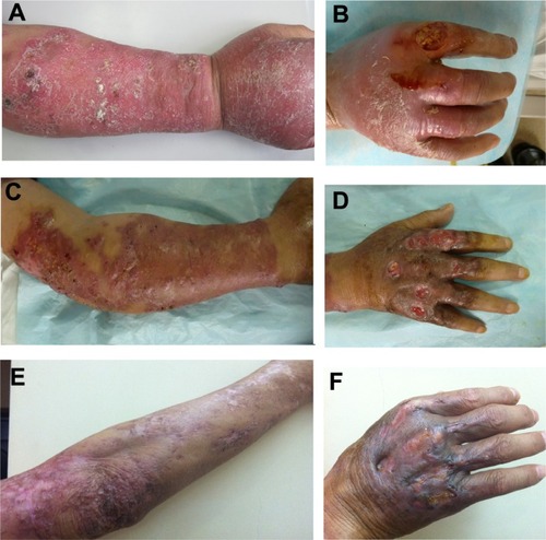 Figure 1 Skin lesions. (A and B) Before treatment a large area of immersed erythema and edema with nodules, ulcerations, and crusts scattered on the right upper limb was present. A nummular deep ulcer with a severe tenderness presented on the back side of the second digit. (C and D) After 2 months of therapy the skin nodules decreased in size and the ulcer cavity was filled with fresh tissues. (E and F) After 6 months of therapy the lesions subsided, leaving some hyperplastic scars.