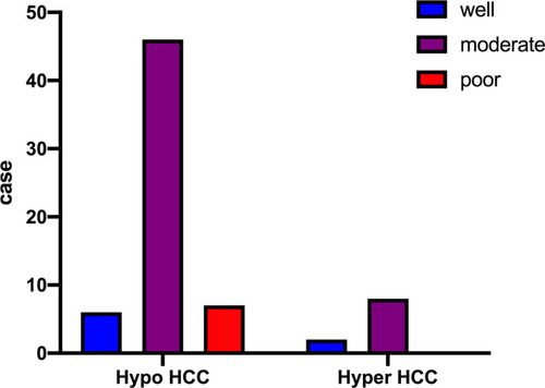 Figure 3 Graph showing tumor differentiation. The hypointense HCCs (hypo) consisted of well- differentiated (n = 6), moderately differentiated (n = 46), and poorly differentiated HCCs (n = 7), while 80% (n = 8) of hyperintense HCCs (iso/hyper) were moderately differentiated.