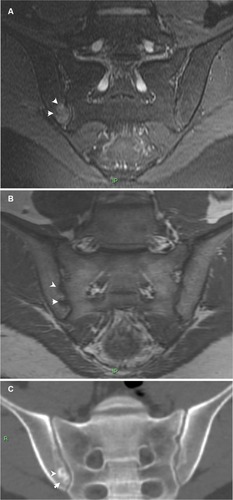 Figure 1 Early sacroiliitis.Notes: Semicoronal MRI T2-weighted with fat saturation (A), T1-weighted (B) and semicoronal CT reconstruction (C) images of the SIJs of a 21 year old male with early sacroiliitis. BME is clearly seen on the right iliac side of the joint (arrowheads in A) as well as small erosions at the same location (arrowheads in B and C).Abbreviations: BME, bone marrow edema; CT, computed tomography; MRI, magnetic resonance imaging; SIJ, sacroiliac joint.