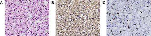 Figure 5 Pathological results of the intracranial space-occupying lesion after the second operation. Haematoxylin–eosin (H&E) staining of biopsy samples (40×) magnification). (A) Immunohistochemical staining results of the intracranial space-occupying lesion after the second operation showed GFAP (small part +) (B), ki-67 (5%, partial 5–10%) (C).