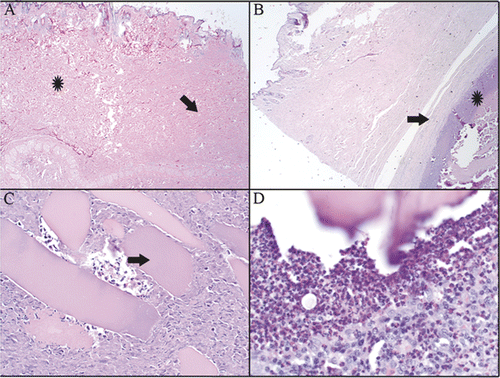 Figure 5. H&E staining of histological slides that were taken from tissue collected at the ablation site at 10 weeks post CITT treatment. Complete dermal healing (A). Dense mature fibrous tissue (arrow) is present in healed dermis. Adjacent dermis (star) is normal. Residual inflammation was present in 10/12 animals (B, C, D). (B) Cellular debris and inflammatory cells (star) are walled off by a capsule of fibrous connective tissue (arrow). (C) Fragments of skeletal myofibres (arrow) are surrounded by necrotic cellular debris and inflammatory cells. (D) Inflammatory infiltrate surrounding myofibre. H&E, magnification 20× (A), 40× (B), 200× (C) and 400× (D).