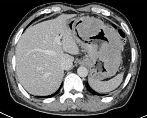Figure 1 CT of the neck, chest, abdomen, and pelvis showed a tumor in the stomach (5×6 cm) with perigastric lymphadenopathy.
