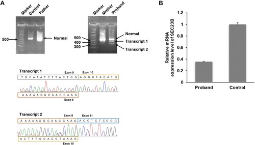 Figure 2. Results of mRNA analysis. (A) RT-PCR analysis extending from exon 7–12 of the SEC23B gene was conducted for the proband, his parents, and healthy controls. Three different products were present in the proband and his mother, who harbored SEC23B c.994-3C > T. The upper band corresponds to the wild-type product, the middle band to the exon 9-deleted product, and the lower band to the exon 9 and exon 10-deleted product. Sequencing analysis of RT-PCR products from the proband confirmed the generation of multiple mutant transcripts. (B) SEC23B mRNA levels in blood samples from the proband and healthy controls.