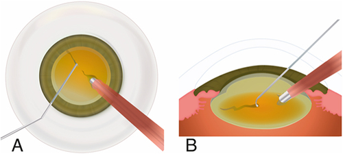Figure 3 (A) In the phaco chop technique, ultrasound was applied with the 0.9 mm 45° Kelman to penetrate the nucleus. (B) Lateral view of the horizontal mechanical chop performed, obtaining two halves.