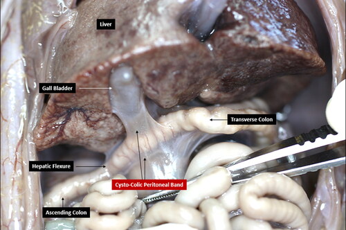 Figure 4. Cysto-colic peritoneal band between the gall bladder and the colon.