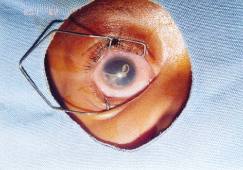 Figure 1 Intraocular adult Loa loa worm.