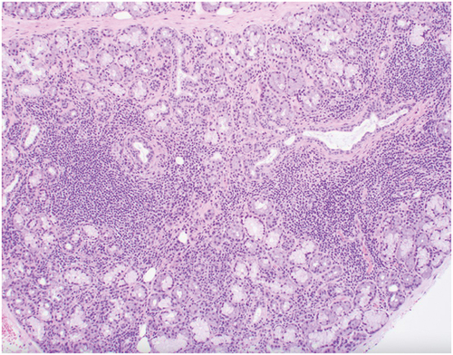 Figure 2. Focal lymphocytic sialadenitis consistent with the salivary component of Sjögren’s syndrome. (Image courtesy of Gretchen Folk, DDS, MS. Scripps Oral Pathology Services, San Diego).