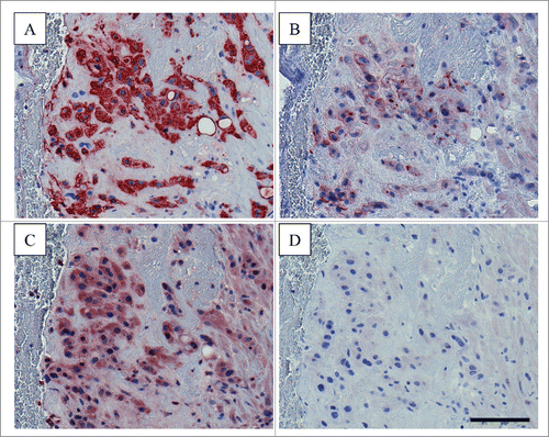 Figure 1. Immunohistochemical staining for fractalkine and CX3CR1 in human postpartum decidua Serial postpartum decidua sections (5 µm) obtained from human hysterectomy were stained for (A) extravillous trophoblast marker HLA-G (using clone 4H84, BD Pharmingen, 0.25 µg/ml working concentration), (B) fractalkine (using monoclonal anti-human CX3CL1/fractalkine antibody, clone 81513, R&D Systems, 1 µg/ml), C) CX3CR1 (using polyclonal anti-CX3CR1 antibody C8354, Sigma-Aldrich, 2 µg/ml) and (D) Negative Control for Rabbit IgG Ab-1 (Neomarkers, Thermo Scientific, 2 µg/ml). Staining was performed using the UltraVision Large Volume Detection System HRP Polymer Kit (Thermo Fisher Scientific) as previously described.Citation21,29,38 Invading extravillous trophoblasts were positive for fractalkine and CX3CR1. Scale bar represents 100 µm.