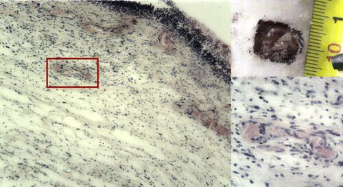Figure 4 The wound crater center by the end of the 3rd day after wound modeling, SC group. The granulation tissue edema extends to deeper tissues. Hematoxylin–eosin staining. Magnification: X40, x400.