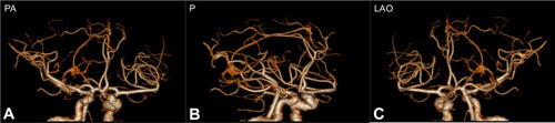 Figure 2 Computed tomography angiography (CTA) showed no evidence of macrovascular embolism in (A) posteroanterior (PA), (B) posterior (P) and (C) left anterior oblique (LAO) view.