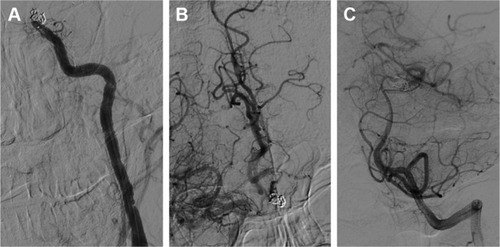 Figure 7 Head DSA images showing the left internal carotid artery was occluded distal to the ophthalmic segment, and no collateral circulation was found.