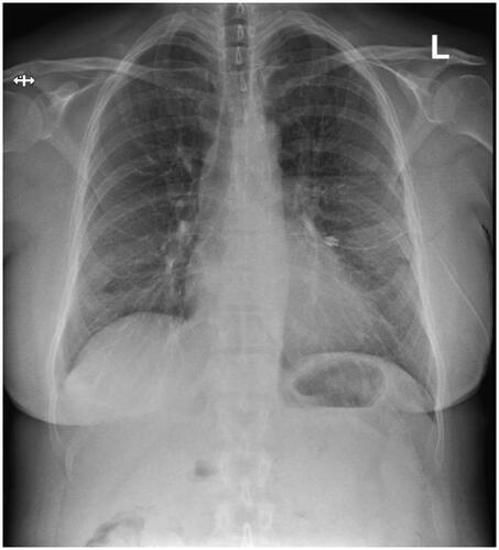 Figure 2. Chest X-ray after insertion of a chest drainage tube showing resolution of the pneumothorax.