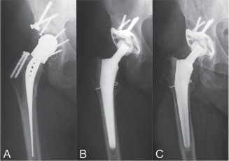 Figure 3. Case description. A 44-year-old female patient with aseptic loosening of the primary THA 5 years after implantation for developmental dysplasia of the hip with an acetabular shelf graft. (A) Intraoperative defect size AAOS 0, no additional bone grafting (A), postoperative (B) and 25 years after revision (C).