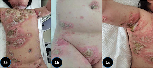 Figure 1 (a–c) Upon admission on April 7, the patient’s whole body was covered with dense pustules, local congestion was evident, dandruff and dry scabs were scattered, and some abscesses coalesced into the blemish.