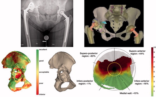 Figure 1. Bone quality assessed by the software; red color reveals a poor and green shows excellent bone quality. (a): Assessment of bone quality as described by Gelaude. (b): Defect analysis quantifies in percentages and colors bone loss in the different regions of the acetabulum on which the Paprosky classification is based. Red color reveals an inferior and green shows excellent bone quality while yellow is acceptable. The output data consists of a ratio and a graph, which allow the direct comparison between specimens. The amount of original acetabular bone that is missing is defined as a ratio. The remaining bone stock in the radial direction is presented by the graph (c).