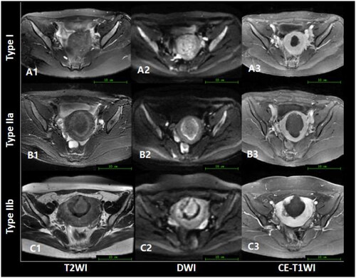 Figure 2. T2WI (A1, B1, C1), DWI (A2, B2, C2), and CE-T2WI (A3, B3, C3) images post-treatment. As we can see, the subtype IIa and IIb ablation areas on T2WI or DWI had similar morphology with corresponding non-perfused area on CE-T1WI (B3 and C3).