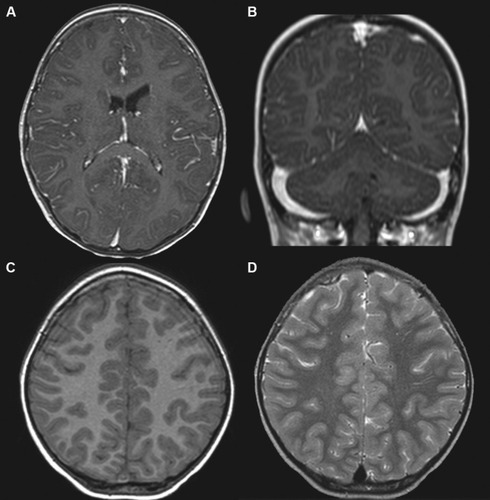 Figure 1 Brain MRI of a 3-year-old girl with anti-N-methyl-d-aspartate receptor encephalitis.