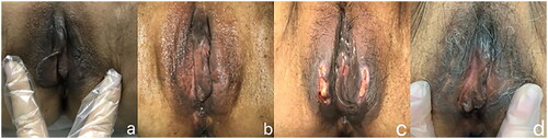 Figure 1. Side effects after FU treatment at 4.0 mm focal depth and the recovery of symptomatic treatment. (a) one patient’s vulvar lesion before FU treatment, (b) the same patient’s vulvar condition immediately after FU treatment, (c) the same patient’s ulcer 12 days after operation and (d) the same patient’s recovery after symptomatic treatment for 7 months after FU therapy.