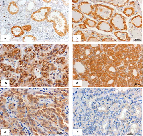 Figure 7. Immunohistochemistry stain of STC1 in different thyroid lesions. (a) Kidney tissue used as a positive control. (b) MNG, (c) NIFTP, (d, e) PTC, these cases express low level of miR-146b-5p and show positive STC1 staining in the cytoplasm/nucleus of thyroid follicular cells. (F) PTC sample with high miR-146b-5p expression showing negative staining of STC1. Scale bar is 20 μM.