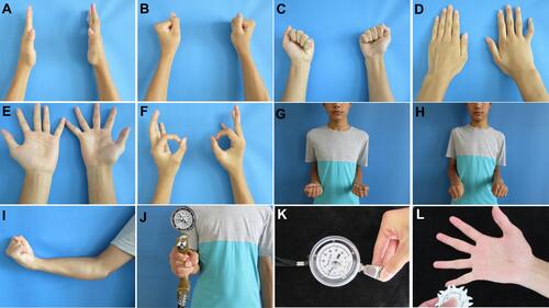 Figure 7 The results of typical case 1 at the 48-month follow-up. (A–C) Completely normal finger flexion and extension; (D–F) The function of the intrinsic muscles of the hand was determined to be normal by observing abduction motions of fingers 1–5; (F) Froment’s sign was negative, and atrophy of the first interosseous dorsal muscle was not apparent; (G, H) Normal forearm pronation and supination; (I) Flexor muscle strength was scored as level 5; (J) The grip strength of the affected hand (the patient was right-hand dominant) was 35 kg; (K) The pinch strength of the affected hand was 9.5 kg; (L) On the affected side, static two-point discrimination of the fingertips was equal to 6 mm.