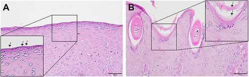 Figure 5 Histologic features of the Guinea pig model of dermatophytosis without dual-diode laser treatment. (A and B) In the skin specimens obtained from each infected laser-untreated Guinea pig, fungal hyphae (arrows in inlets) were apparent in the hyperkeratotic stratum corneum of the spongiotic psoriasiform epidermis: Periodic acid-Schiff staining, original magnification ×400.