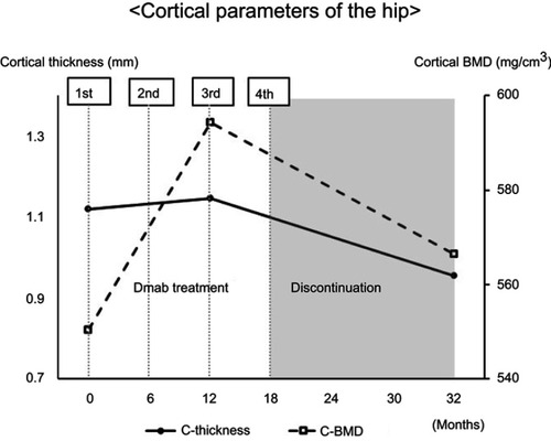Figure 4 Cortical parameters of the hip measured by QCT. QCT revealed that the cortical parameter (cortical thickness and cortical BMD) decreased after discontinuation of denosumab treatment.