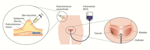 Figure 4. Route of administration of sasanlimab and BCG. Sasanlimab is administered by subcutaneous injection into the adipose tissue layer below the epidermis and dermis. BCG is administered by intravesical instillation directly into the bladder via a urinary catheter.BCG: Bacillus Calmette-Guérin.