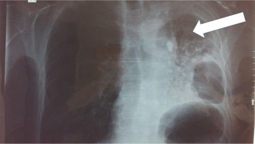 Figure 3 After 28 days under afatinib 40 mg (the mass has started to shrink and the left lung to inflate, white arrow).