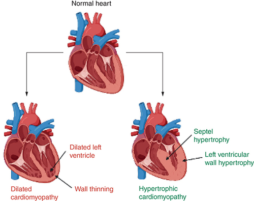 Figure 2. Difference in cardiac pathology between hypertrophic cardiomyopathy and dilated cardiomyopathy.Created with Biorender.com.