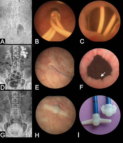 Figure 1 Appearance of ureteral stents by X-ray and endoscopy. (A) The patient was fitted with Polaris™ Loop stents (Boston Scientific) but acute kidney injury occurred, and stent-related symptoms adversely affected patient comfort. (B) Endoscopic appearance of the ureteral orifice with a Polaris™ Loop stent. (C) Loop of Polaris™ stent overlapping the bladder neck and causing bladder irritation in this patient. (D) In 2017, the patient was fitted with reinforced pigtail-suture stents. With this design, the bladder loop was replaced with a thin suture thread invisible on X-rays. (E) Ureteral orifice with sutures of the pigtail-suture stent. (F) Sutures of the pigtail-suture stent (arrow) away from the bladder neck, avoiding any conflict with the bladder. (G) In 2021, the pigtail-suture stents were replaced by customized reinforced ureteral stents with an end-piece for sudden ureteral orifice obstructions. The end-piece is invisible on X-rays. (H) End-piece of a customized stent in the ureteral orifice. The orifice obstruction had to be bypassed by a rigid stent segment and not by the suture and the end-piece was embedded at the bottom of the stent to prevent the stent from slipping into the ureter. The customized stent is bound firmly in place to the ureteral orifice, avoiding any conflict with the bladder neck. (I) End-piece of a customized stent and its two side wings. The wings are flexible enough to allow introduction into the urethra.