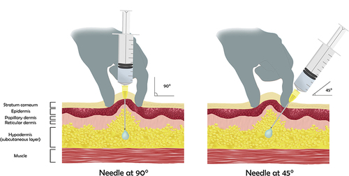 Figure 3 The subcutaneous application technique at an angle of 90° and 45°.