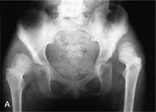 Figure 1 Case 10. A girl who was 6 years old at the index operation for bilateral hip dislocation. A. At the initial examination (bilateral hip dislocation). B. 1 year after open reduction, capsulorrhaphy, femoral shortening, and Salter innominate osteotomy, showing adequate reduction. C. After removal of implant.