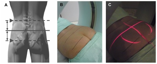Figure 1 Preparation for SI joint injection. Based on the anatomic landmarks, the midline between the major trochanter and iliac crest is identified (A) and marked on the skin (B). The target laser of the scanner is brought into an overlapping position with the marked midline (C).
