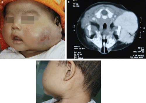 Figure 1.  A girl born in November 18, 2008 with huge hemangioma in the left parotid gland was treated with oral propranolol at a dose of 1.5 mg/kg/day. (A) Before treatment at the age of 3.5 months. (B) MRI showed a large mass with high signal intensity in the left parotid gland. (C) Lateral view at the age of 22 months, the tumor completely disappeared after oral propranolol treatment for 7 months.