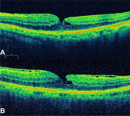 Figure 15 Macular pseudohole.