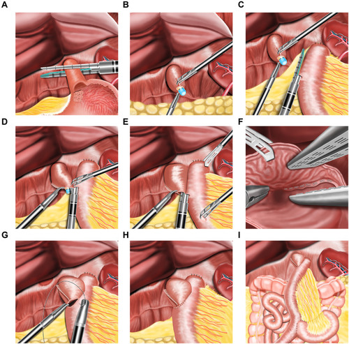 Figure 3 Schematic representation of the technique of esophagojejunostomy after totally laparoscopic total gastrectomy by overlap method. (A) Division of the distal esophagus with a linear cutting closure device. (B) The gastric tube is passed through the cut end of the esophagus. (C) One arm of the linear staple is inserted into the proximal jejunum. (D) Under the guidance of nasogastric tube, the other arm of linear stapler is inserted into the stump of the esophagus. (E) The staples were fired and the esophagojejunal linear anastomosis is performed. (F) Hemostasis along the staple line is confirmed. (G) Closure of the common opening with barbed suture. (H) Completion of the esophagojejunal anastomosis. (I) The overview of all the anastomoses after the completion of the surgery.