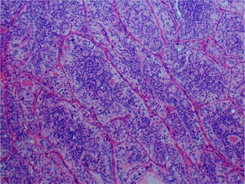 Figure 5 Case 2: Hematoxylin–eosin staining showing islands of small uniform cells, areas of tumor necrosis, and microfollicles.