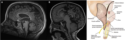 Figure 1 (A) Normal Brain MRI of a pediatric patient; (B) Brain MRI findings of a pediatric patient with Chiari Malformation Type II (CM-II); (C) Illustration showing elongation and compression of anatomical structures of the brainstem and spinal cord. Note that both central respiratory centers and the nuclei of the vagus and glossopharyngeal nerves are involved. This leads to increased risk of central apnea and/or upper airway obstruction.