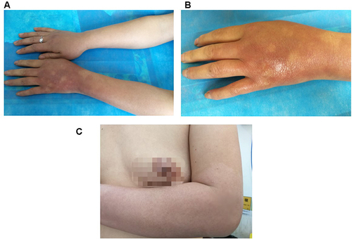 Figure 1 Skin lesions on the left arm. (A–C), different directions to show the skin lesions on the left arm.