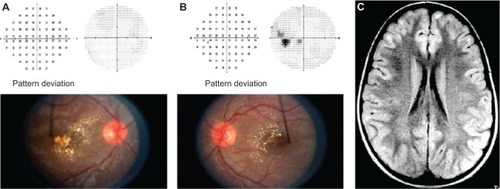 Figure 6 Automated visual fields, fundus of both eyes, sequential axial FLAIR MRI.
