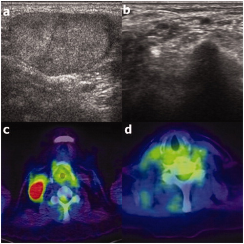 Figure 3. Ultrasound (US; a) and positron emission tomography-computed tomography (PET-CT; c) images of recurrence at right cervical level 4 in an 81-year old female patient. At the 122-month follow-up, complete disappearance of the recurrence was observed on US (b); it was also noted at the 39-month follow-up on PET-CT (d).