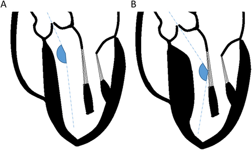 Figure 2 Left ventricle to aortic root angulation and its impact on left ventricular outflow tract gradient. (A) In structurally normal hearts, the left ventricular to aortic root angle (LVARA) is greater than 140°. (B) With septal hypertrophy, the LVARA decreases, and more blood is directed toward the anterior leaflet of the mitral valve. This is thought to promote a Venturi effect and drag forces that increase the left ventricular outflow tract gradient and promote systolic anterior motion of the mitral valve.