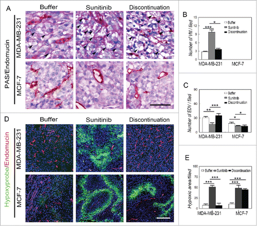 Figure 2. Effects of sunitinib treatment on the microcirculation patterns in TNBC tumors. (A) PAS and endomucin double staining in TNBCMDA-MB-231 and non-TNBC MCF-7 tumors. There were VM channels formed by PAS-positive molecules and tumor cells in the human TNBCMDA-MB-231 tumors, whereas no VM channels were observed in the human non-TNBC MCF-7 tumors. Growth of endothelium-dependent vessels in the TNBC MDA-MB-231 tumors was blocked by sunitinib, during which the number of VM channels significantly increased. Endothelium-dependent vessel growth rebounded in MDA-MB-231 tumors after treatment discontinuation, but there was no significant difference in the number of endothelium-dependent vessels between sunitinib-treated and post-treatment non-TNBC MCF-7 tumors. (B)Quantification of VM channels in the different groups. (C)Quantification of endothelium-dependent vessels in the different groups. (D)Hypoxia and endomucin double staining inTNBCMDA-MB-231 and non-TNBC MCF-7 tumors. There were more hypoxic regions in the sunitinib-treatedMDA-MB-231 tumors compared with those in the other groups when the endothelium-dependent vessels are inhibited. After treatment discontinuation, the hypoxic area in the MDA-MB-231 tumors decreased after the endothelium-dependent vessels rebounded. The hypoxic area in the MCF-7 tumors was similar in the sunitinib-treated and discontinued groups. (E)Quantification of the hypoxic area in the different groups. The scale bar indicates 100 μm, and the error bar indicates the standard deviation (SD). * P < 0.05, **P < 0.01, ***P < 0.001.