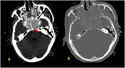 Figure 1. (A, B) Unenhanced axial CT brain images revealed complete hyper-attenuating soft tissue opacification of the expanded sphenoid and ethmoid sinuses as well as visualized maxillary antra with sinus walls destruction and infiltration into cavernous sinus bilaterally and pre pontine cistern. Dense basilar artery indicating thrombosis (red arrow).