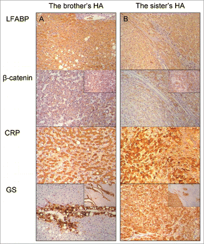 Figure 3. Subtype classification by immunohistochemical analysis. (A) The brother's HA; (B) The sister's HA. From upper panels to lower panels: LFABP, β-catenin, CRP and GS. All original magnifications are 100×; the magnification of the insets in β-catenin is 200× to show the sub-cellular distribution of the positive staining, and the magnification of the insets in GS is 40× to show the homogeneous or heterogeneous distribution of the positive staining.